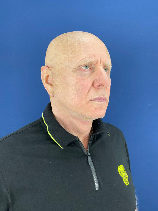 Цены на операцию SMAS-лифтинг